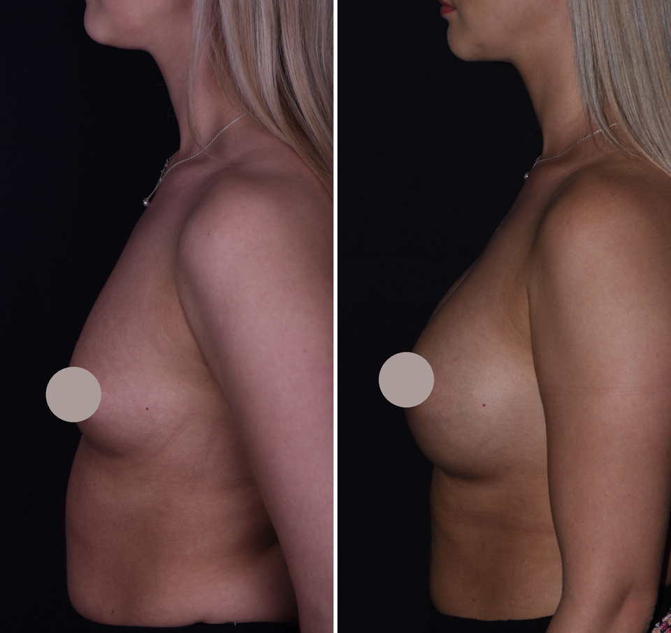 Augmentation mammaire — Comparaison 4