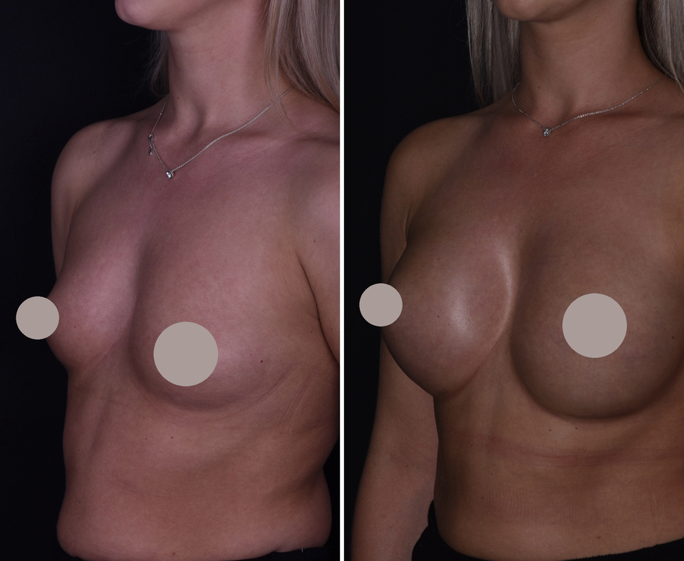 Augmentation mammaire — Comparaison 5