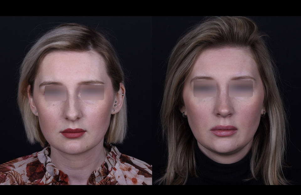 Avant à gauche, après à droite — Face