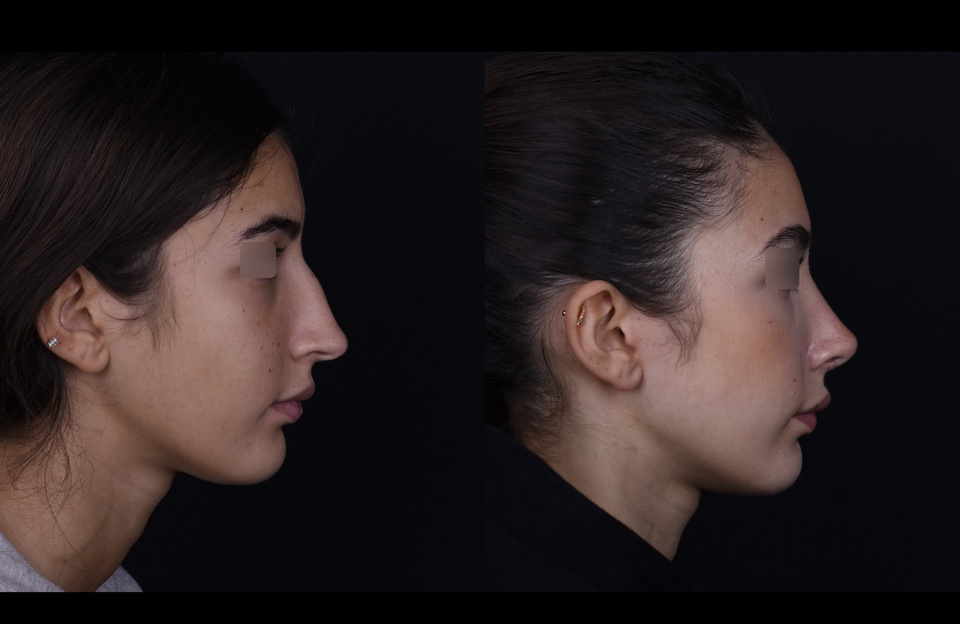 Avant à gauche, après à droite — Autre profil